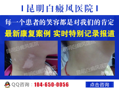 白癜风的防治